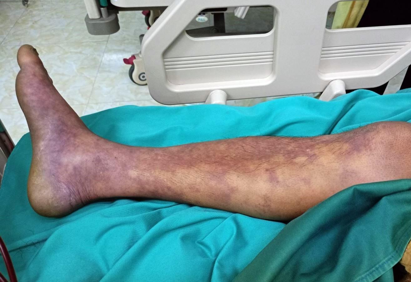 CÁC THÔNG ĐIỆP PHÒNG CHỐNG BỆNH LIÊN CẦU LỢN Ở NGƯỜI
